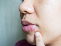 6 Tanda Herpes di Bibir yang Sering Diabaikan tapi Berbahaya
