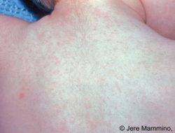 Perbedaan Campak dan Roseola, Jangan Bingung!