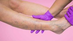 Kenali Tanda dan Penanganan Varises